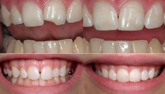 фото зубов после реставрации